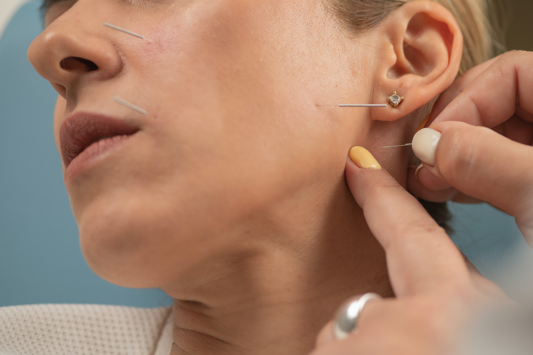Acupuncture treatment for Bell's palsy